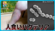 【致死率30%】人食いバクテリア過去最多に 8年前に感染し右脚を失った女性が語る恐怖【めざまし8ニュース】
